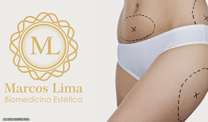 Pacote completo! 5 Sessões de ultrassom focalizado, 5 sessões de radiofrequência, 5 Sessões de Hidrolipoclasia não aspirativa com receita para manipulação de ativos para emagrecimento saudável no Marcos Lima Biomedicina Estética em até 18 vezes no cartão*