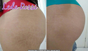 O mais novo método para acabar com as estrias indesejáveis! Camuflagem de estrias e cicatrizes na Estética Leda Rossi anexo ao Salão da Jô