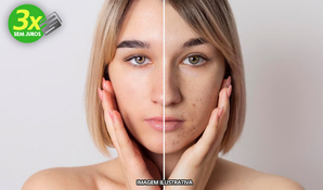 BELLADAY ESTETICA: 1 sessão de peeling retinóico para tratamento de acnes e manchas faciais