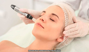 CRICIÚMA ESTÉTICA: 1 sessão de microagulhamento fotobiomodulado em até 12x no cartão* válido de segunda a sexta