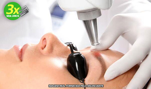 ESTÉTICA AVANÇADA SÔNIA GARCIA: 1 sessão de despigmentação das sobrancelhas com laser